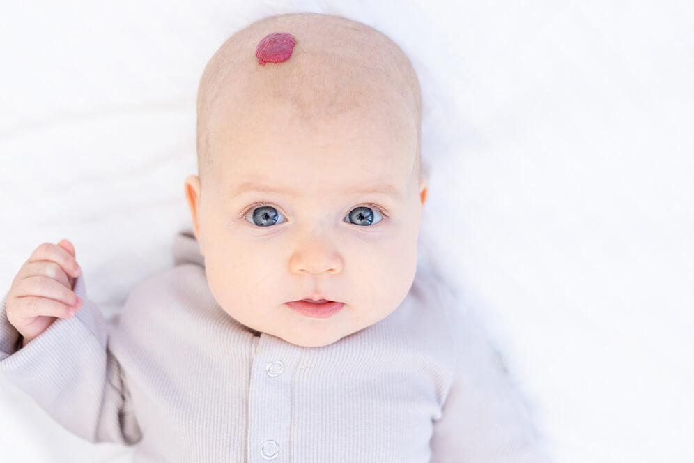 Baby mit Blutschwämmchen auf dem Kopf - Ästhetische Dermatologie – MVZ Die HautTypen GmbH, Merzhausen 